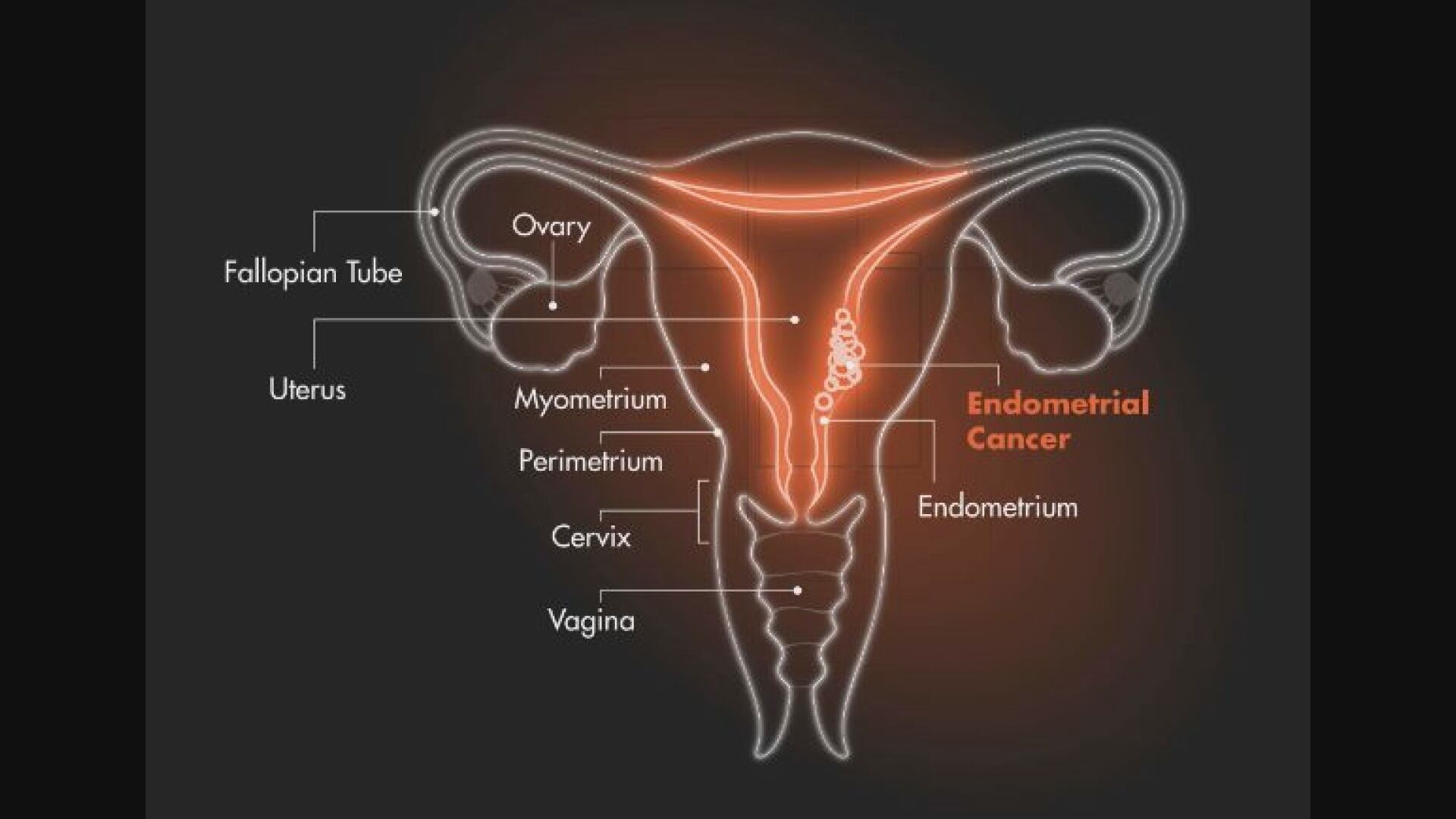 Woman and doctor highlight rising endometrial cancer in younger women